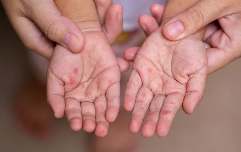 Argentina emite alerta sanitaria por una familia uruguaya con sarampión que recorrió el país en colectivo